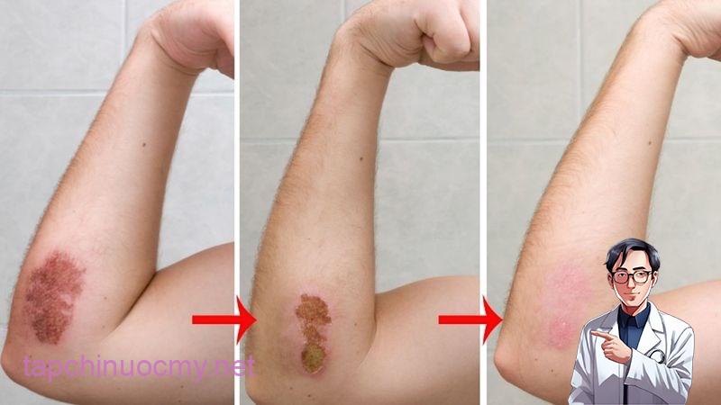 Tính kháng khuẩn, kháng viêm giúp mau lành vết thương