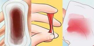 5 dấu hiệu u-ng thư cổ t-ử cung sớm nhất: 90% chị em xem thường bỏ qua