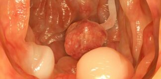Cảnh báo dấu hiệu khi đi ngoài chứng tỏ cơ thể đã bị ung thư đại tràng, cần đi khám gấp
