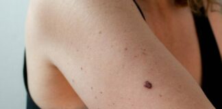 Cảnh báo: Đốm nhỏ trên da có thể là dấu hiệu ung thư – Đừng chủ quan