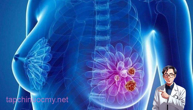 Ung thư vú ngày càng phổ biến