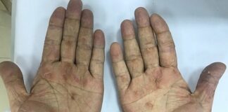 Hàng chục nghìn người nhiễm giun đũa ch;ó m;èo mỗi năm, nguyên nhân do đâu