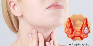 Số lượng u tuyến giáp ngày càng tăng nhanh, bác sĩ khuyên nên ăn ít hơn loại thực phẩm