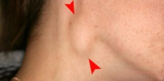 Cảnh báo: 3 dấu hiệu ở cổ cho thấy nguy cơ ung thư, phát hiện sớm để kịp điều trị